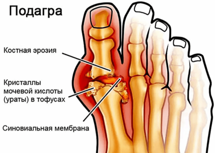 Подагра симптомы и лечение в домашних условиях. Подагра: лечение в домашних условиях Мигрирующая подагра: что это, причины, симптомы и лечение Подагра — симптомы и лечение в домашних условиях | Подагра, Здоровье.