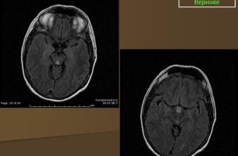 Энцефалопатия Вернике симптомы