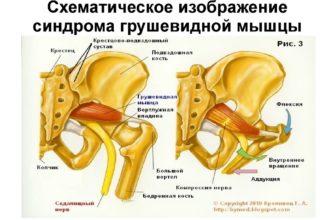 Лечение синдрома грушевидной мышцы