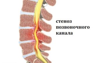 Стеноз позвоночного канала