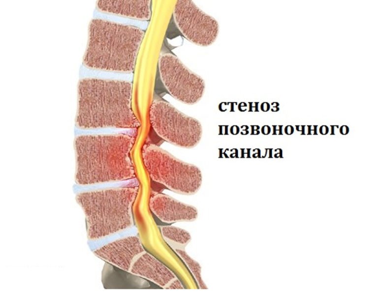 Стеноз позвоночного канала поясничного отдела и шейного операция