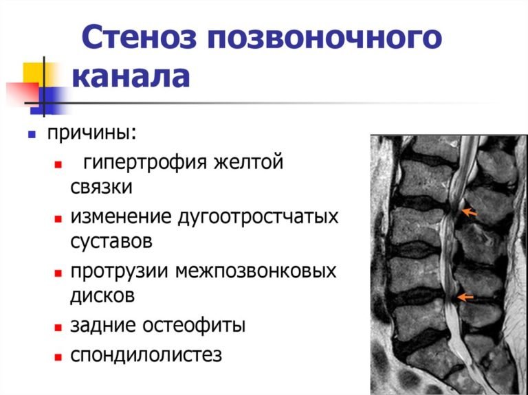 Стеноз позвоночного канала поясничного отдела и шейного операция