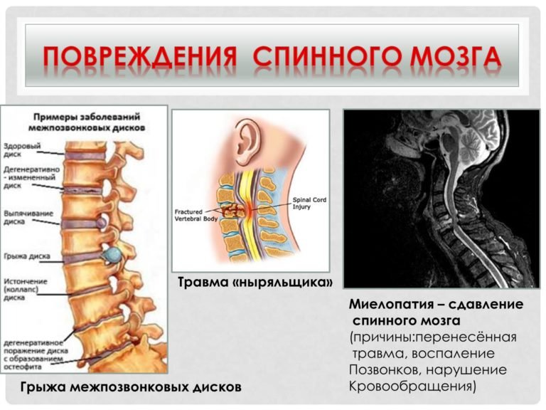 Травмы позвоночника фото