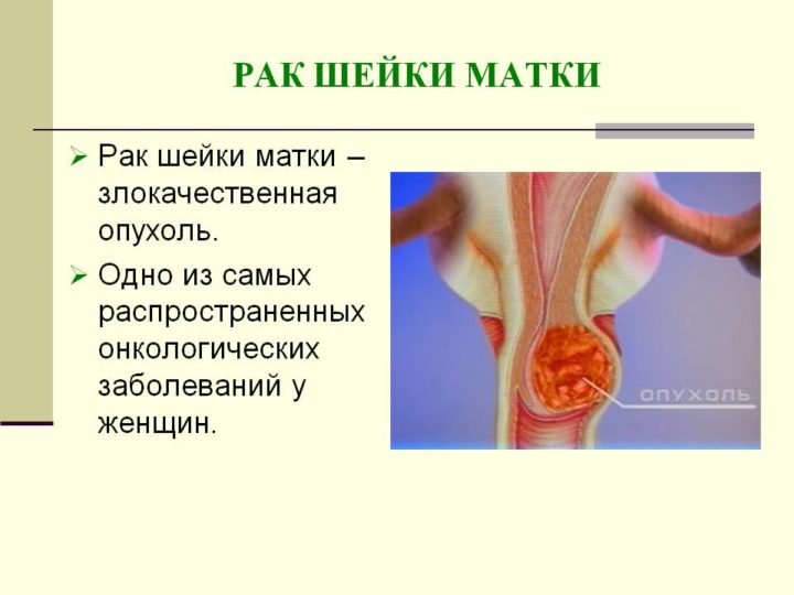 Как выглядит струп после конизации шейки матки фото