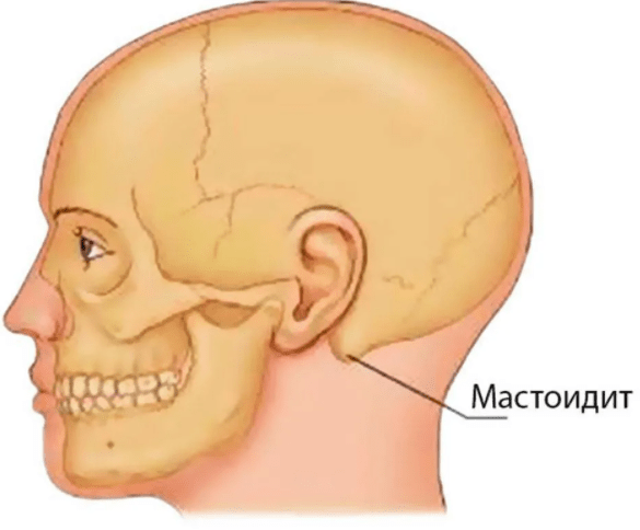 Мастоидит что это, причины, симптомы, диагностика и лечение