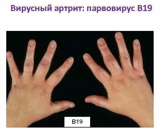 Вирусный артрит симптомы и лечение, клинические рекомендации