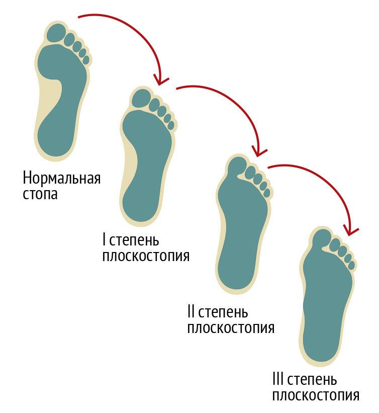 Чем может быть вызвано плоскостопие у человека. Плоскостопие 2 степени и 3 степени. Поперечное III - IV степени плоскостопие. Продольное плоскостопие 2. Плоскостопие у детей причины 3 степени.