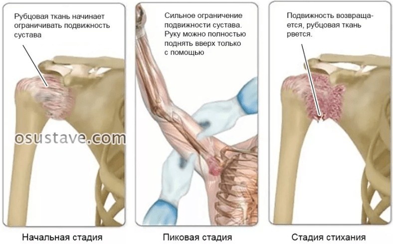 Капсулит плечевого сустава к какому врачу обратиться. Капсулит плечевого сустава (адгезивный): причины, симптомы, как лечить Киста коленного сустава к какому врачу обратиться Капсулит плечевого сустава симптомы и лечение