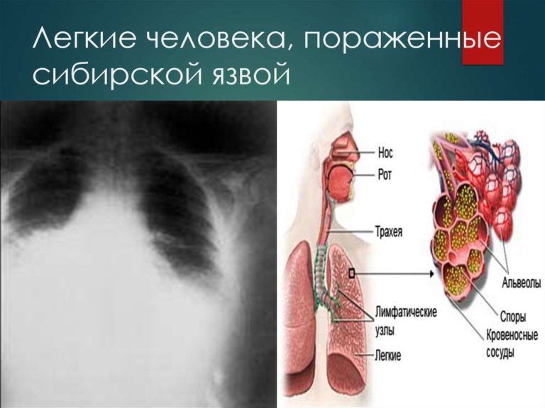 Сибирская язва формы, симптомы, причины, лечение