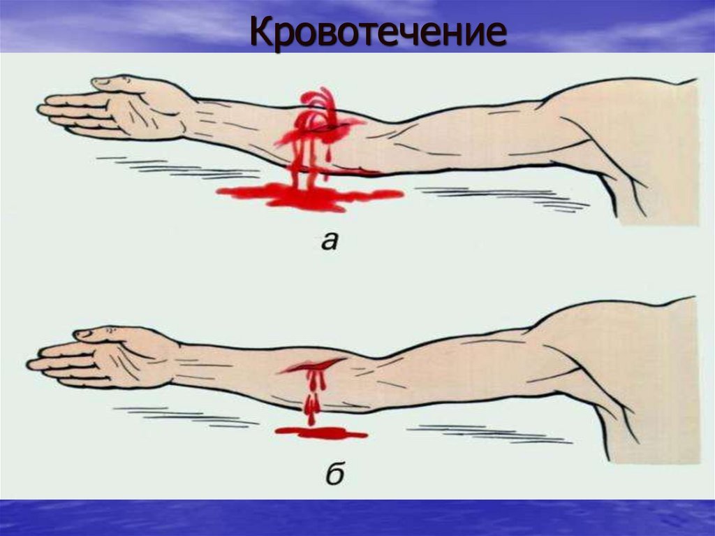 Кровотечение что это и место кровопотери, признаки и симптомы
