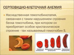 Серповидно клеточная анемия картинки