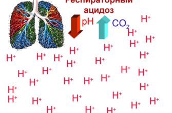 Респираторный ацидоз