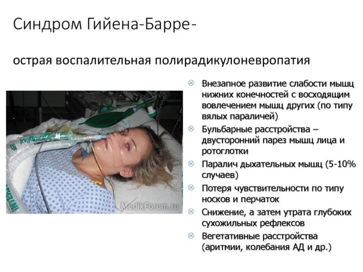 Синдром Гийена-Барре признаки, причины, симптомы и лечение