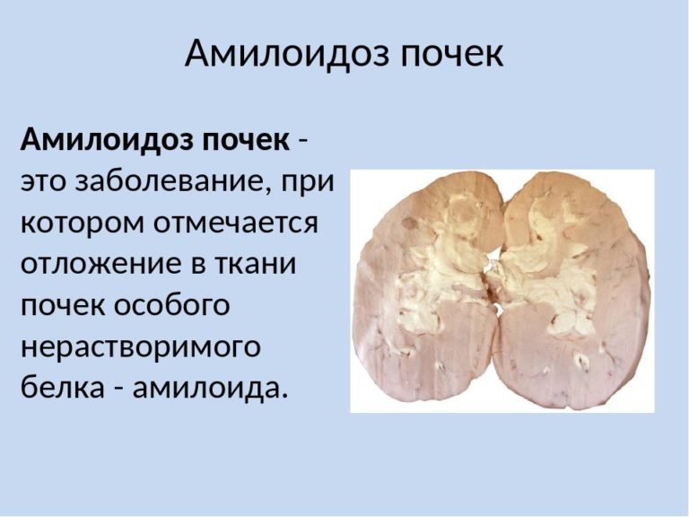 Амилоид типы, заболевания амилоидом