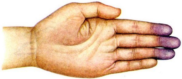 Метгемоглобинемия причины, симптомы и лечение