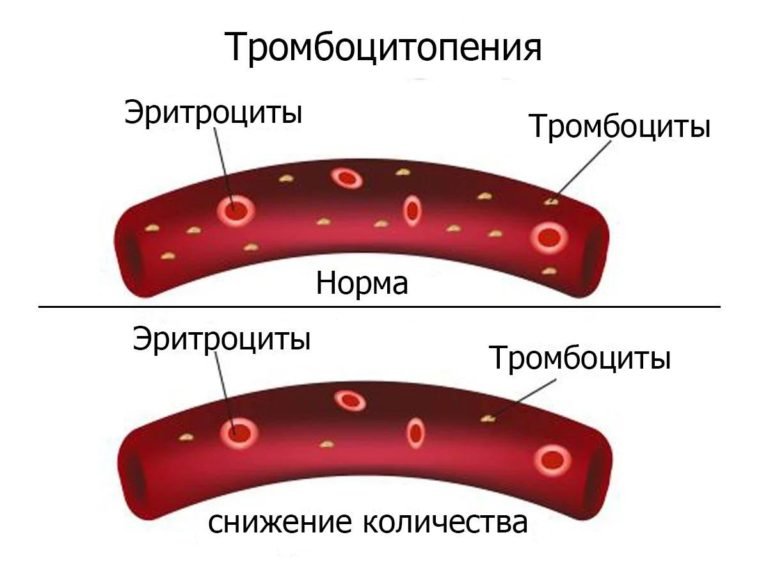 Тромбоцитопеническая пурпура у детей картинки