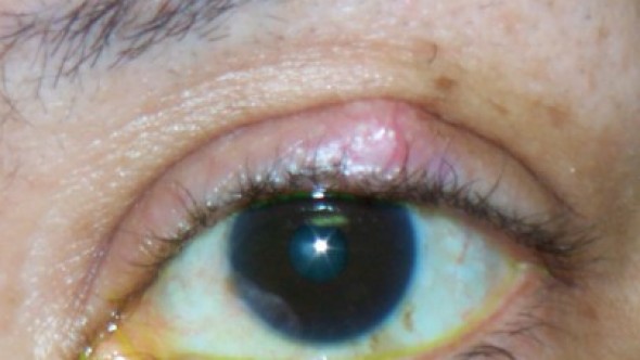 Халязион симптомы причины, лечение халязиона в домашних условиях