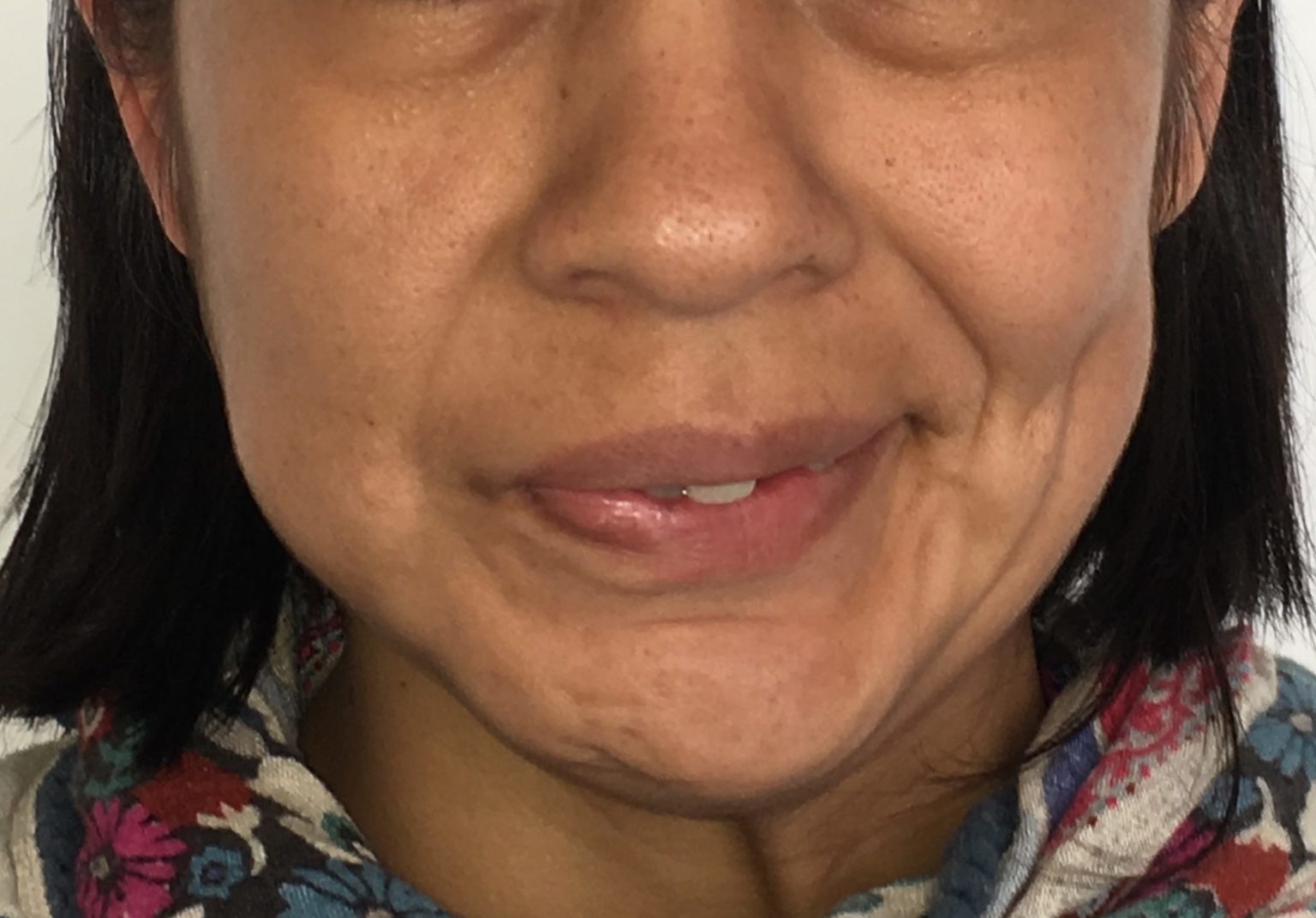 Паралич Белла признаки и симптомы, отличия паралича Белла от инсульта