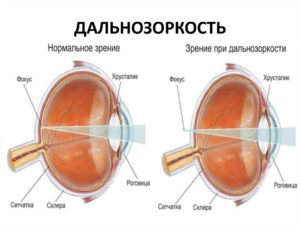 Схема дальнозоркости глаза