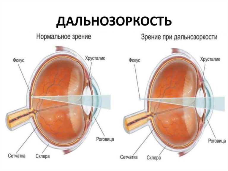 Причина дальнозоркости изображение формируется