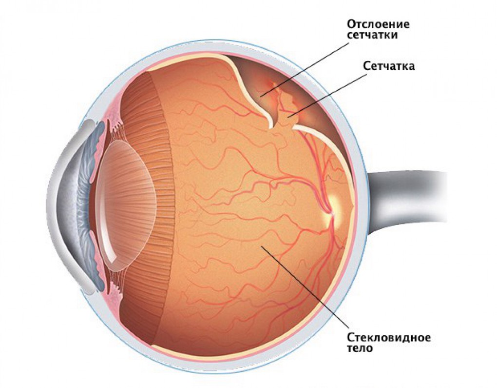 Изображение впереди сетчатки это