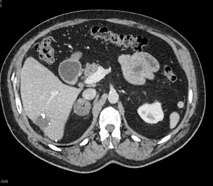 Аденома надпочечника причины, симптомы и лечение аденомы надпочечника