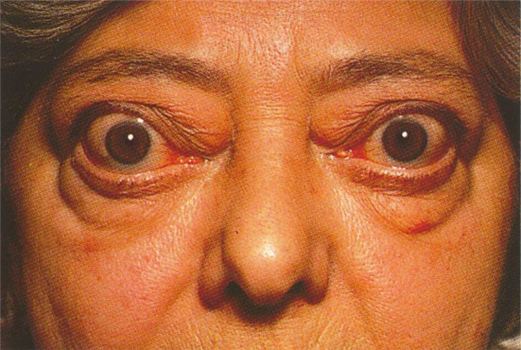 Болезнь Грейвса признаки, причины и лечение