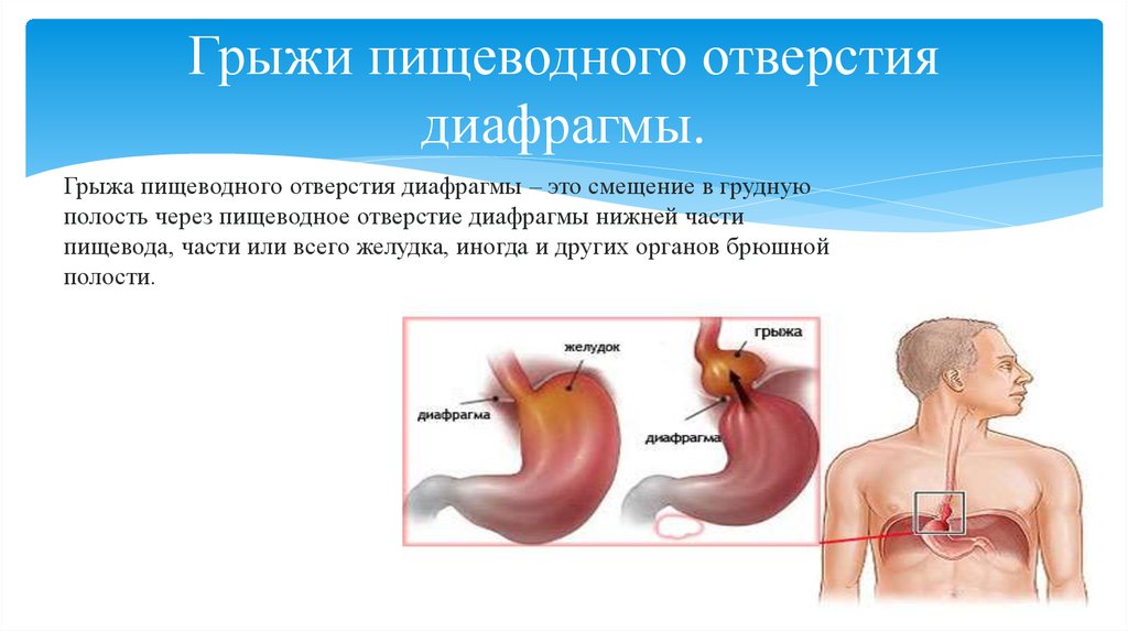 Эндоскопическая картина при грыжах пищеводного отверстия диафрагмы характеризуется