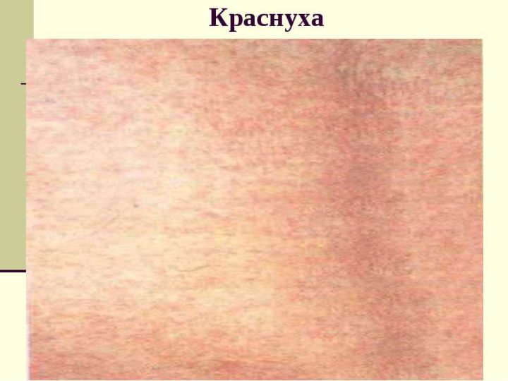 Краснуха у взрослых: симптомы и лечение краснухи у взрослых