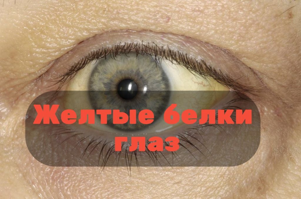 Акантамебный кератит причины, симптомы и лечение