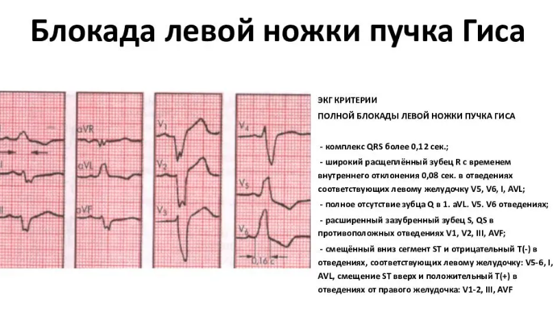 Лечение полная блокада левой ножки